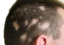 Tratamiento contra la Alopecia areata