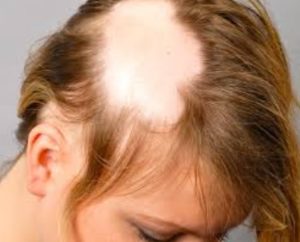 Problemas de la alopecia femenina