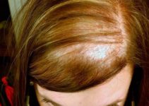 Causas de la alopecia femenina
