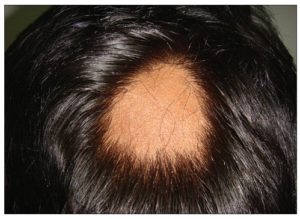 Los tipos de alopecia