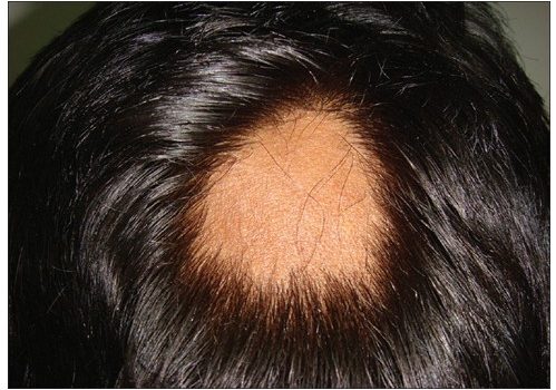 Los tipos de alopecia