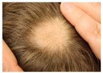 Remedios para la alopecia infantil