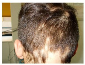Causas de la alopecia en niños