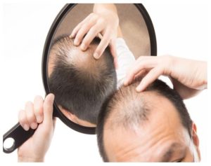 Medicamentos en el postoperatorio de implante de pelo