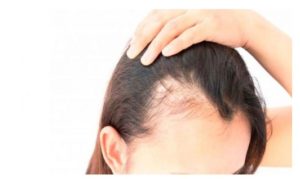 Causas de la alopecia en mujeres
