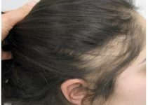 Diagnóstico de las causas de la alopecia